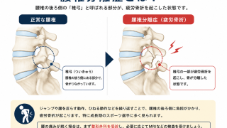 腰椎分離症とは？腰の痛みを「疲れ」で済ませていませんか？