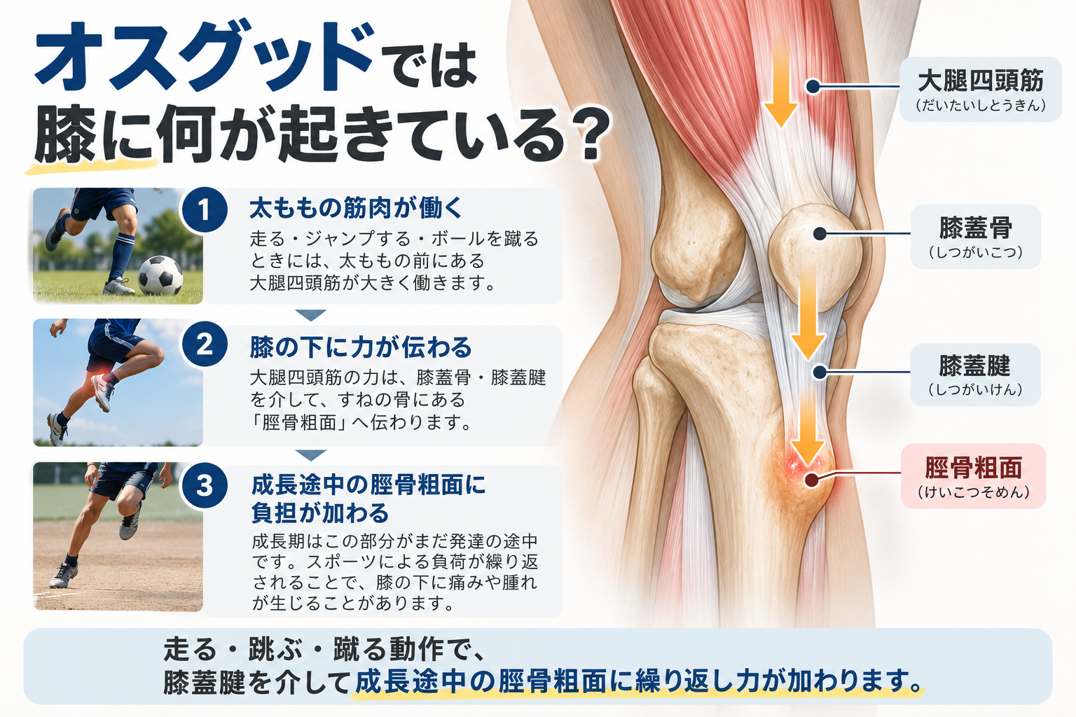 オスグッドで脛骨粗面に負担が加わる仕組み